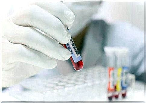 Tests to Diagnose Agranulocytosis