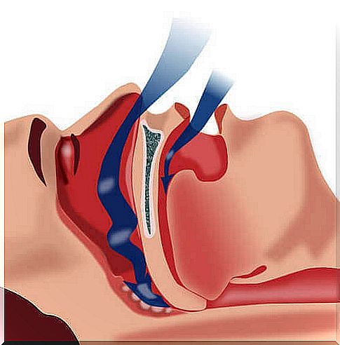 Can you treat sleep apnea naturally?