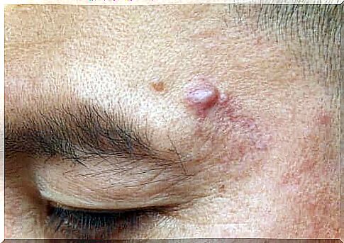 Causes and Treatments for Epidermal Cysts