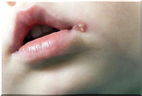 A child with a cold sore