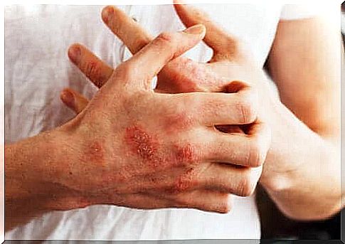 Controlling Psoriasis Through Your Diet