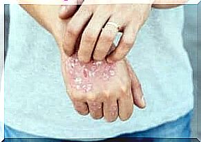 Itching due to psoriasis