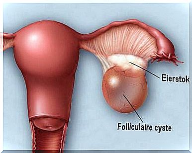 Discovering and preventing ovarian cysts