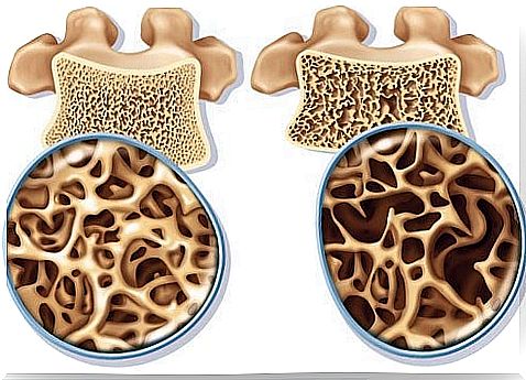 Exercises to Treat and Prevent Osteoporosis