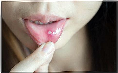 How can you treat canker sores and mouth ulcers?