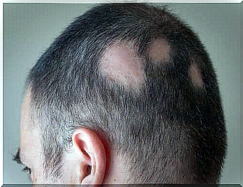 A man has bald spots on his head