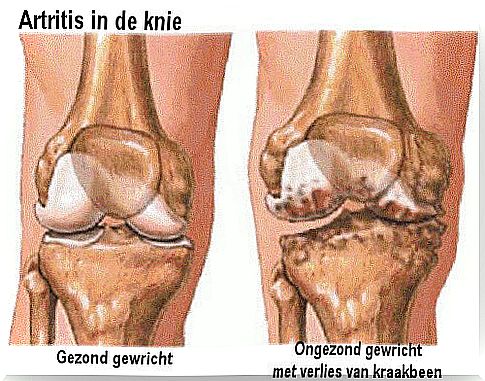 Arthritis in the Knee