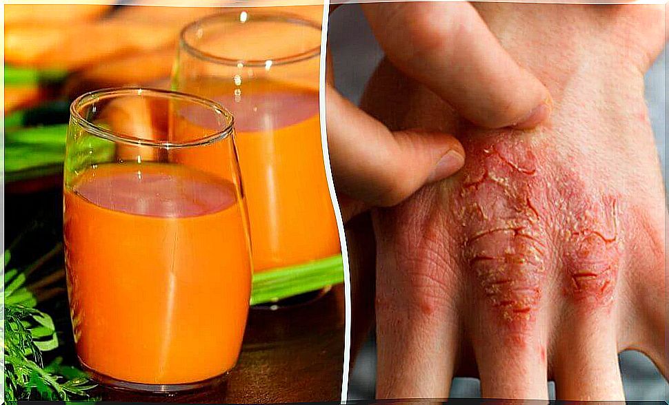 Prevent and fight skin condition psoriasis with these 7 natural remedies