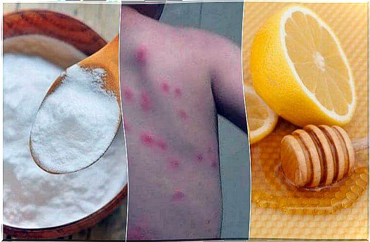 Relieve flea bites with 5 home remedies