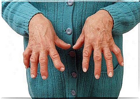 Relieving Rheumatoid Arthritis With Medicinal Remedies