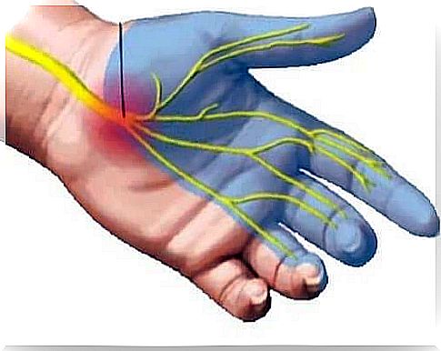 nerve compression