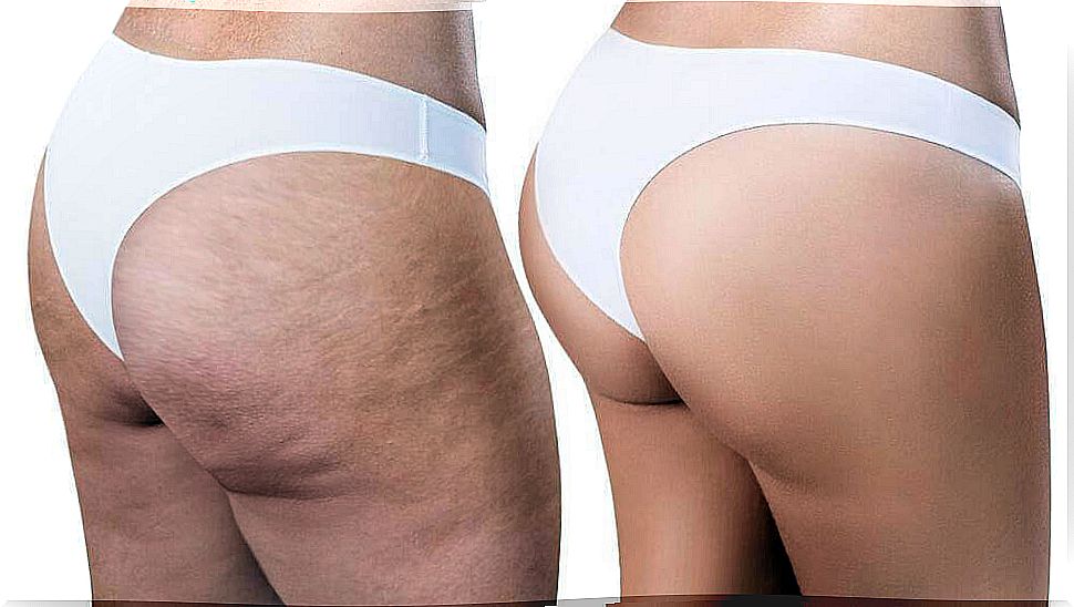 Remove cellulite with these simple and effective home remedies