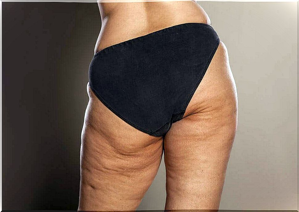 Stages in the development of cellulite