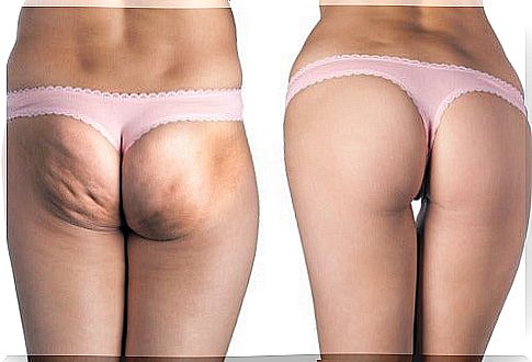 The best natural treatments for cellulite