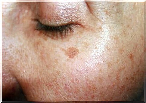 Melasma is one of the skin conditions we are talking about