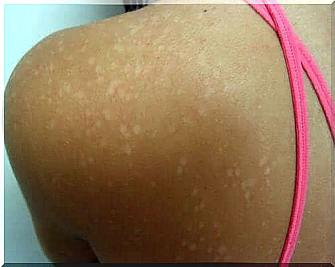 Tinea versicolor or dorsal spots