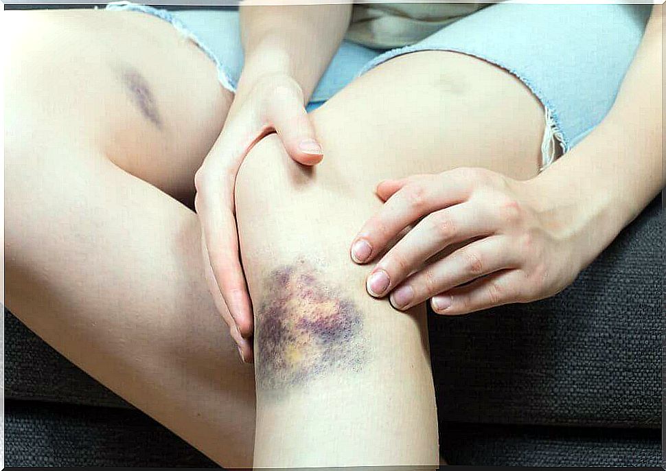 Treat bruises with natural remedies