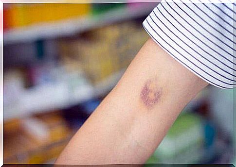 Bruise on arm