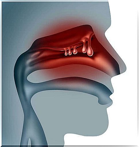 Treating Nasal Polyps Naturally