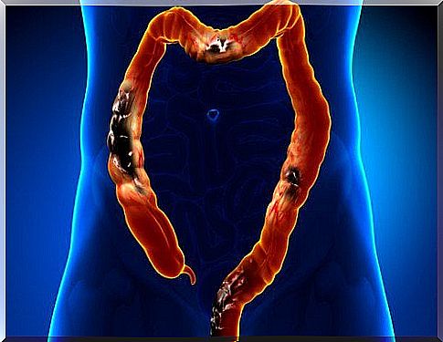 Blockages in the large intestine