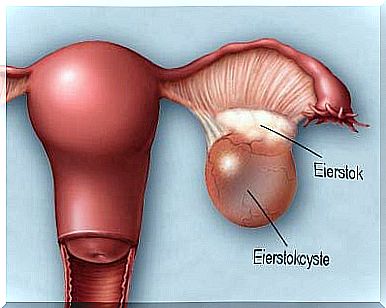 Ovarian cyst and ovary