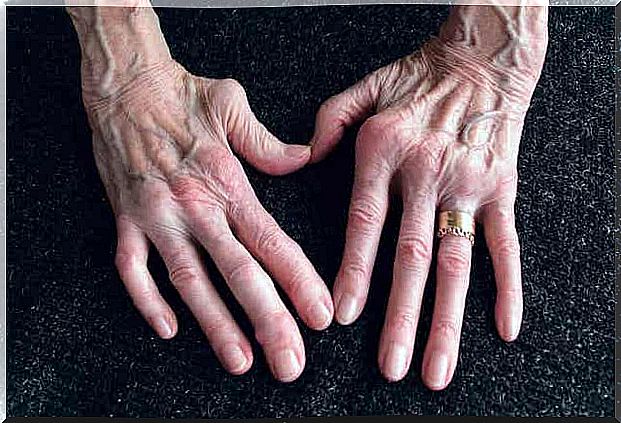 Rheumatoid Arthritis and Wild Yam