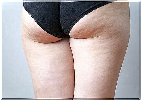 Why you can't get rid of your cellulite